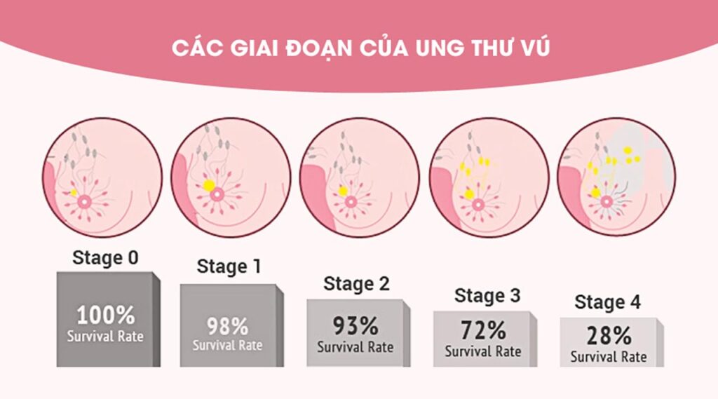 triệu chứng ung thư vú 