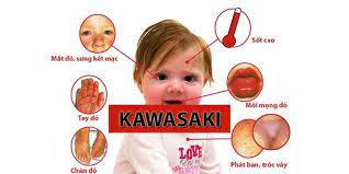  bệnh Kawasaki 