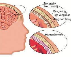 Viêm màng não do não mô cầu