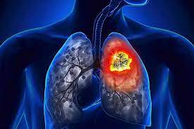 Ung thư phế quản phổi nguyên phát