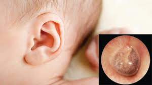 Viêm tai giữa mãn tính ở trẻ em