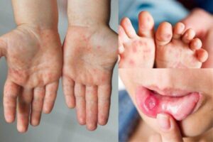 Các bước điều trị khi nhận thấy triệu chứng bệnh tay chân miệng ở bé